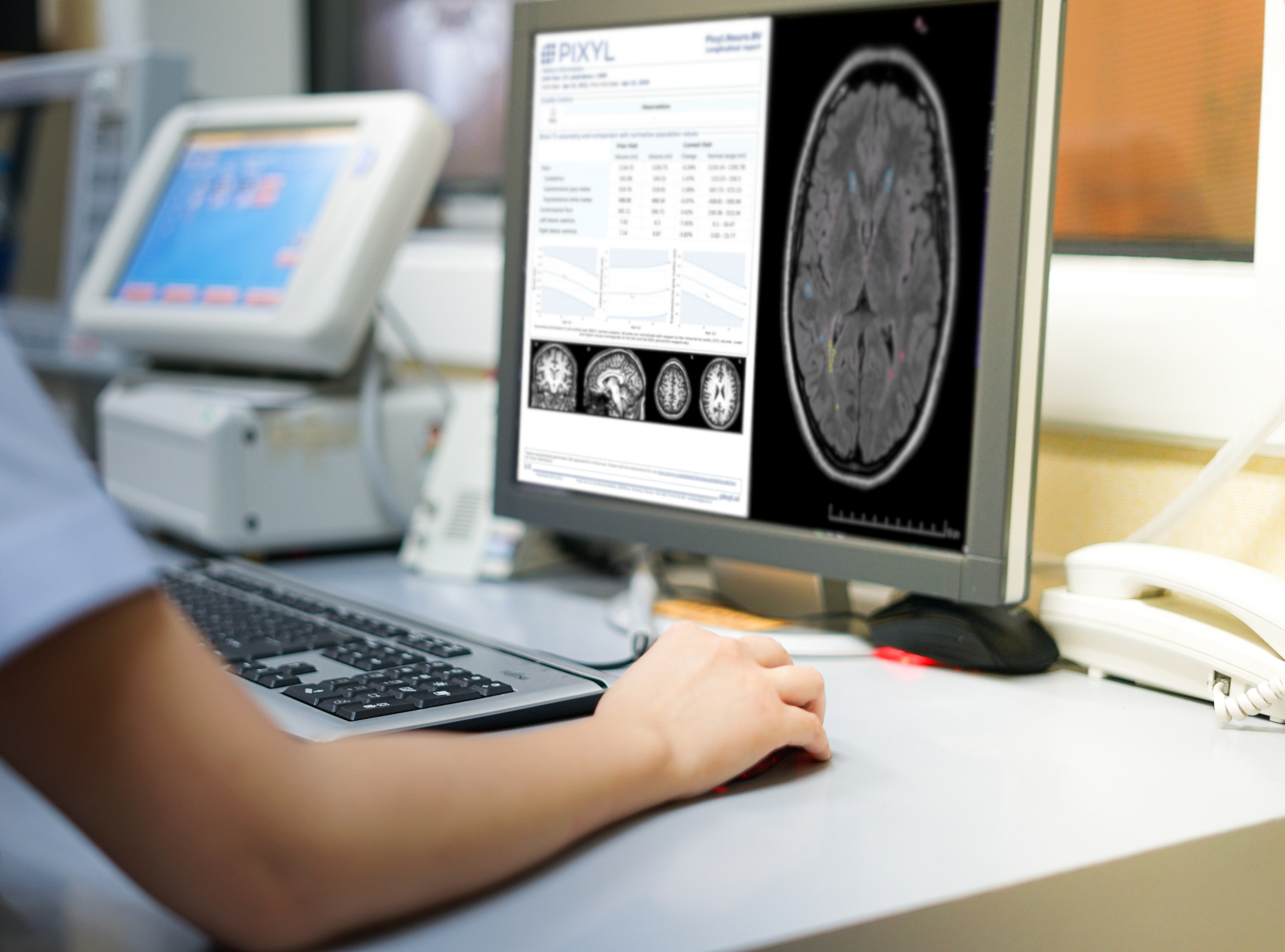 Medtech : Pixyl veut prédire l'évolution des maladies neurodégénératives grâce à l'IA