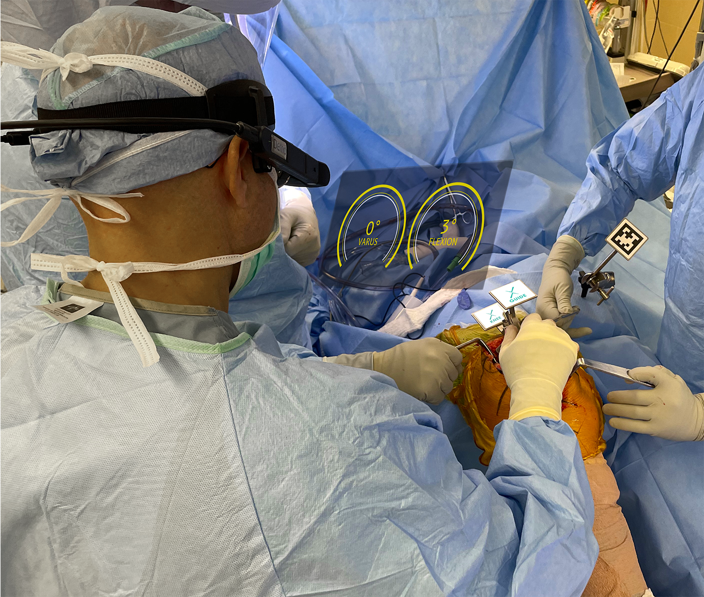 La startup Pixee Medical veut étendre son modèle de lunettes augmentées pour les chirurgiens