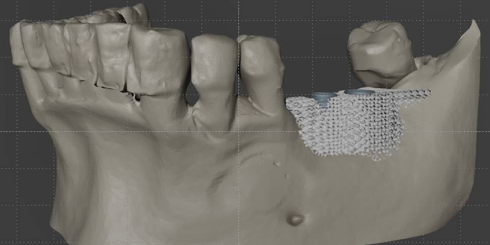 Chirurgie dentaire : Kervalion développe un greffon d'os imprimé en 3D