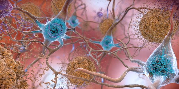 Plaques amyloïdes et protéines Tau dans le cerveau.  NIH Image Gallery, CC BY-NC