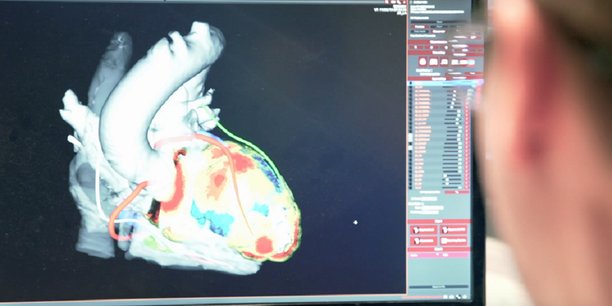 La visualisation en détail du coeur par l'application inHeart (notre photo).