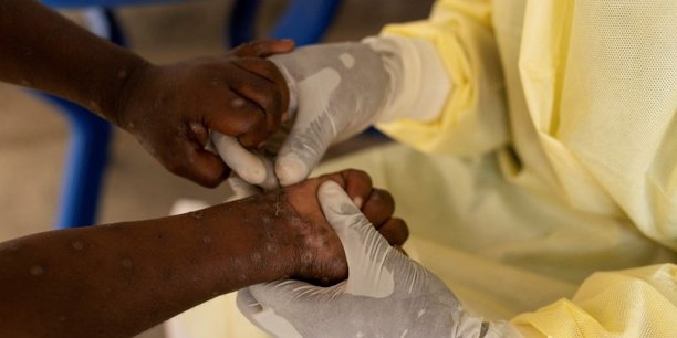 Le mpox est une maladie virale qui cause des éruptions cutanées, de la fièvre, et parfois des douleurs articulaires.